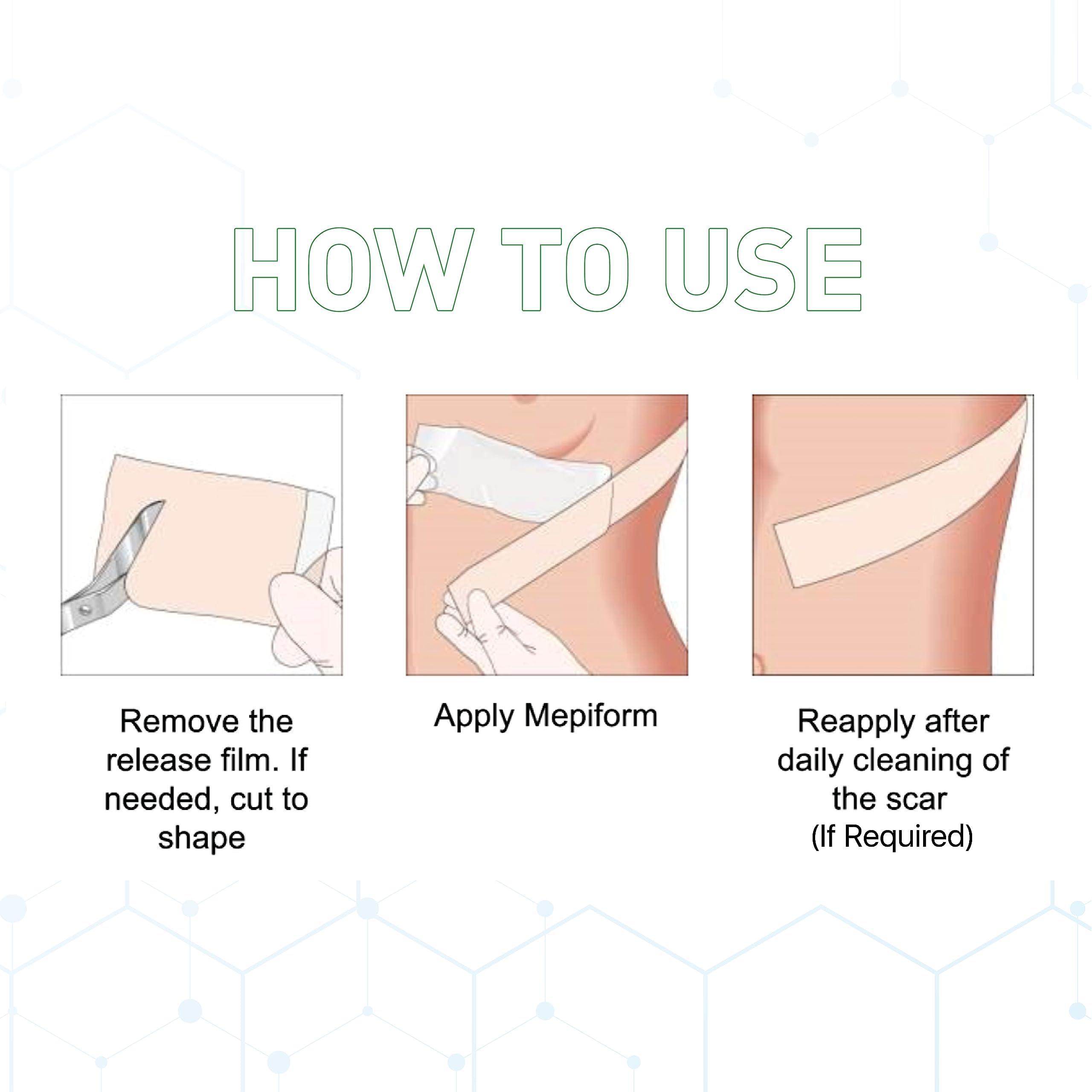 Mepiform Mepiform Reusable Resizable Scar Removal Silicone Gel Sheet Tape, small scar heal patches for Keloid, C Section, Tummy, Acne scars, Surgery, Burns, alike Scar Cream Gel, 5x7.5 cm