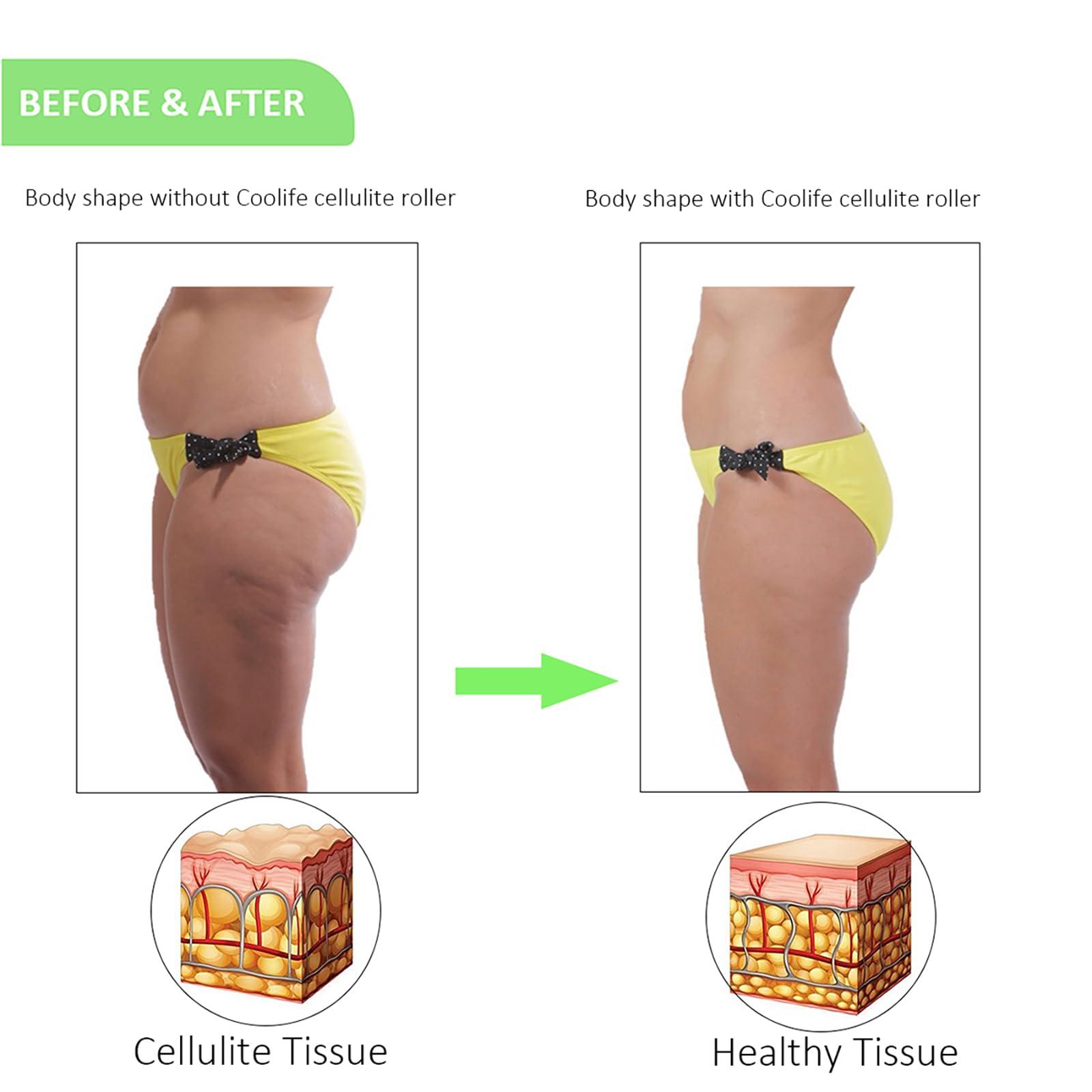 Coolife Coolife Fascia and Cellulite Blaster Remover Muscle Roller