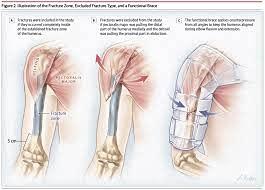 DEBIK DEBIK | Humeral Brace arm support humerus fracture brace (LARGE)