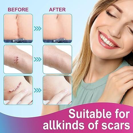 LUPINEZ LUPINEZ Transparent Medical Silicone Gel Tape for Scar Removal,Scar Transparent for Surgical Scar, Silicone Scar Sheets, Silicon gel sheets for Scars