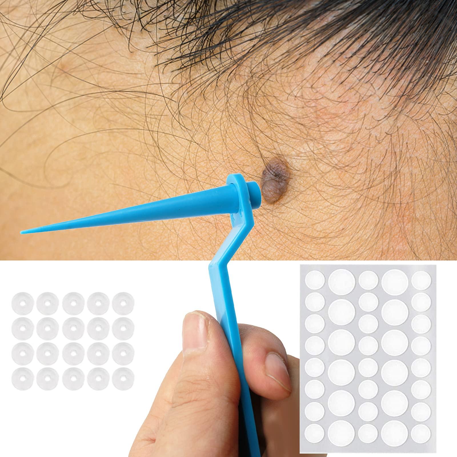QUKAN QUKAN 2 in 1 Skin Tag Remover Set Skin Tag Removal Kit with Rubber Bands Rings for Removing Small to Medium (2mm to 8mm) Sized Skin Tags Painlessly