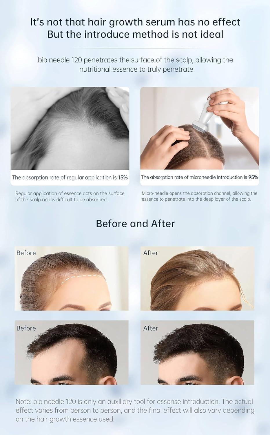 DUNGRANI ENTERPRISE Derma Stamp Adjustable Pen 0mm - 3mm,140 A Titanium micro needles I Amazing Professional Microneedling Pen for Skin Repair, Face, Hair & Beard Growth (Derma Stamp)