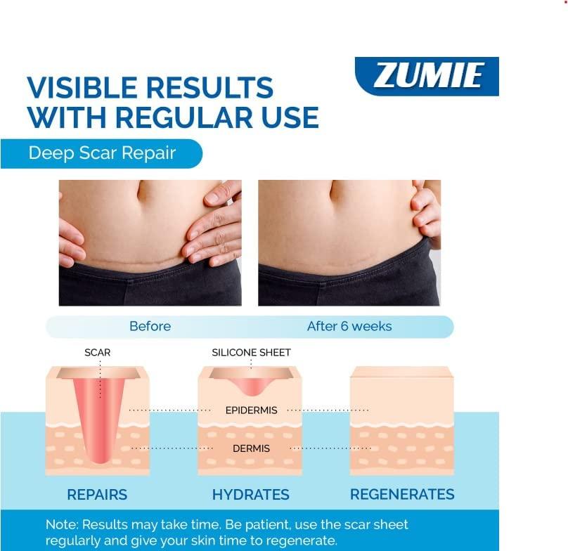 ZUMIE ZUMIE Silicone Scar Removal Sheets Post Surgery & Acne Scars Treatment-2 Month Supply Cica Care Gel Sheets Wound Repair Scar Silicon Soft Long Strips & Sheets (2pcs Scar repair tape)