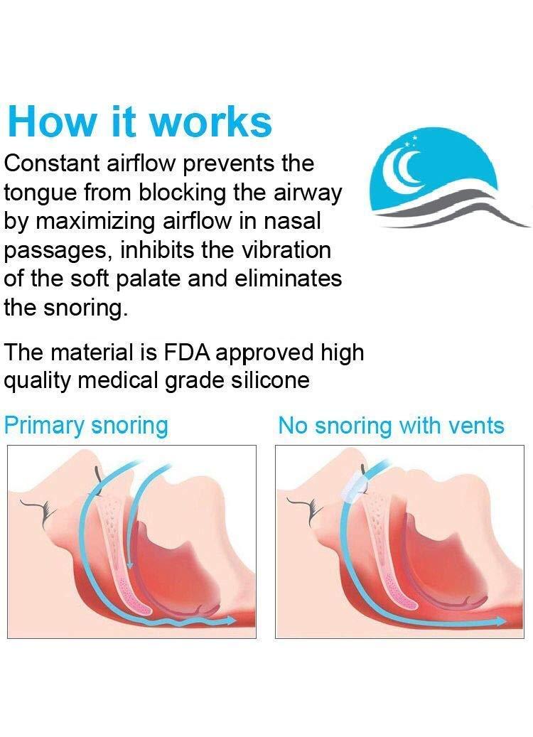 Snore Bastion Anti Snoring Devices by Snore Bastion - All ONE Size (L) Large - Nasal Dilator - Snoring Nose Vents - Snoring Solution - Medical Grade Silicone Snore Stopper - Stop Snoring