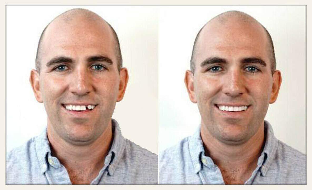 Instant Smile Instant Smile Select A Tooth Temporary Tooth Replacement Kit- Combo