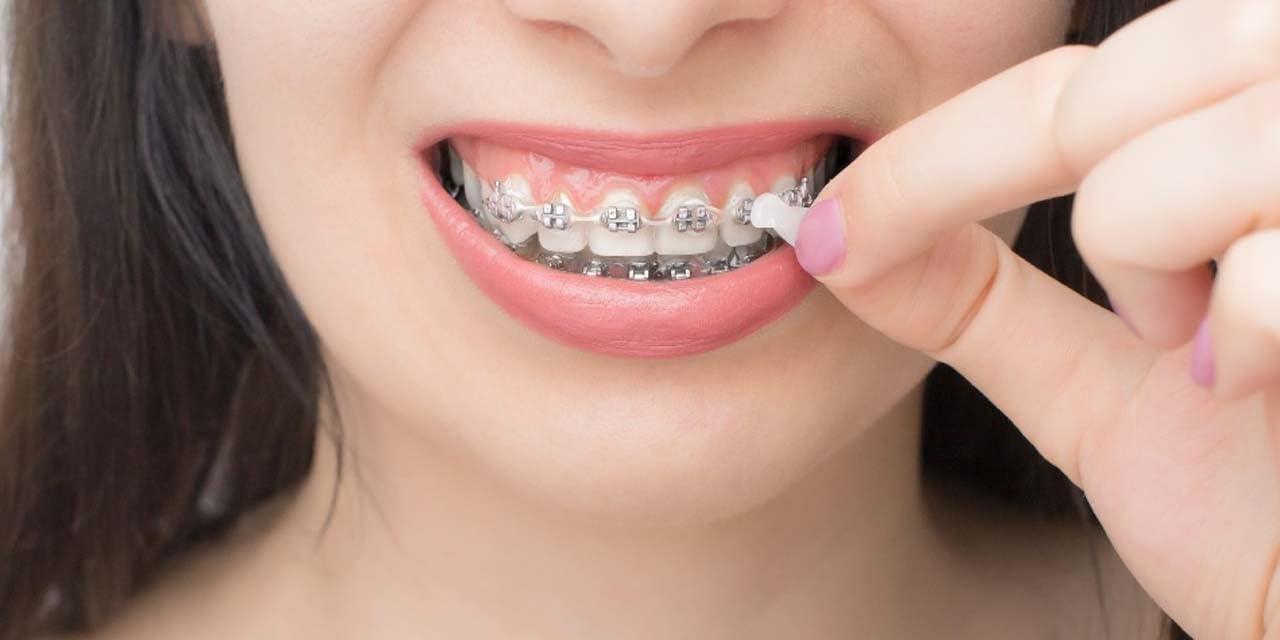 Orthowax By Orthomechanics Genuine Orthowax - Our Bestseller Orthodontic Wax For Braces Wearer - Stick Better than competitors