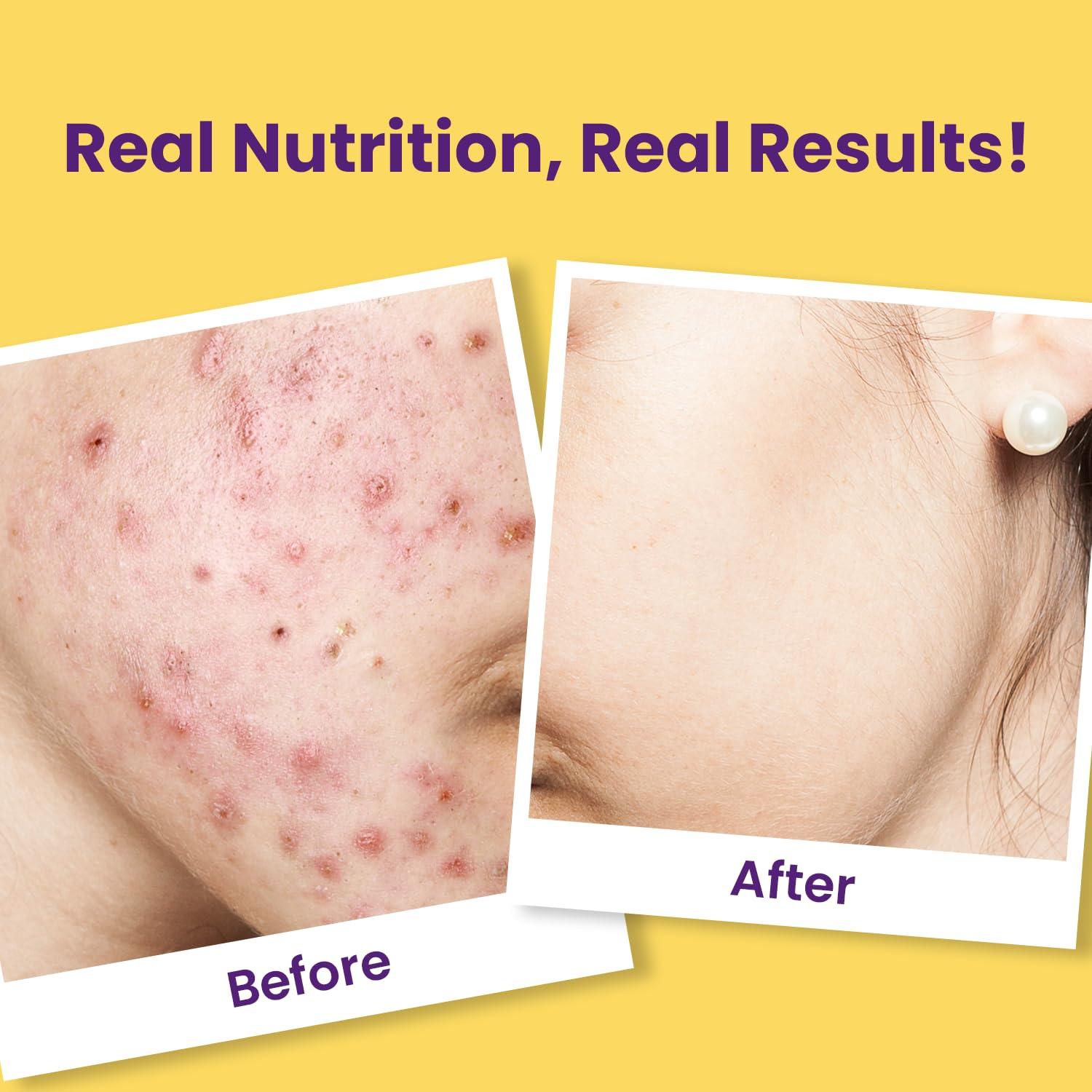 CHICNUTRIX Chicnutrix Super C - Natural Vitamin C & Zinc for Clear & Acne Free Skin | 1000mg Amla Extracts|For Women & All skin types| Orange Flavour | 40 Effervescent Tablets