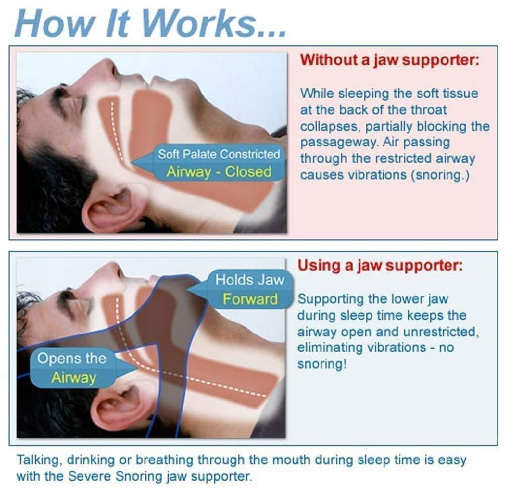 KEDY KEDY 2022 Anti-Snoring Chin Strap Easily Adjustable Snore Stopper Best Snoring Solution | Stop Snoring Anti-Snoring Belt for Men Women Reduces Snoring Solution