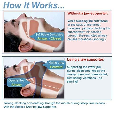 KEDY KEDY 2022 Anti-Snoring Chin Strap Easily Adjustable Snore Stopper Best Snoring Solution | Stop Snoring Anti-Snoring Belt for Men Women Reduces Snoring Solution