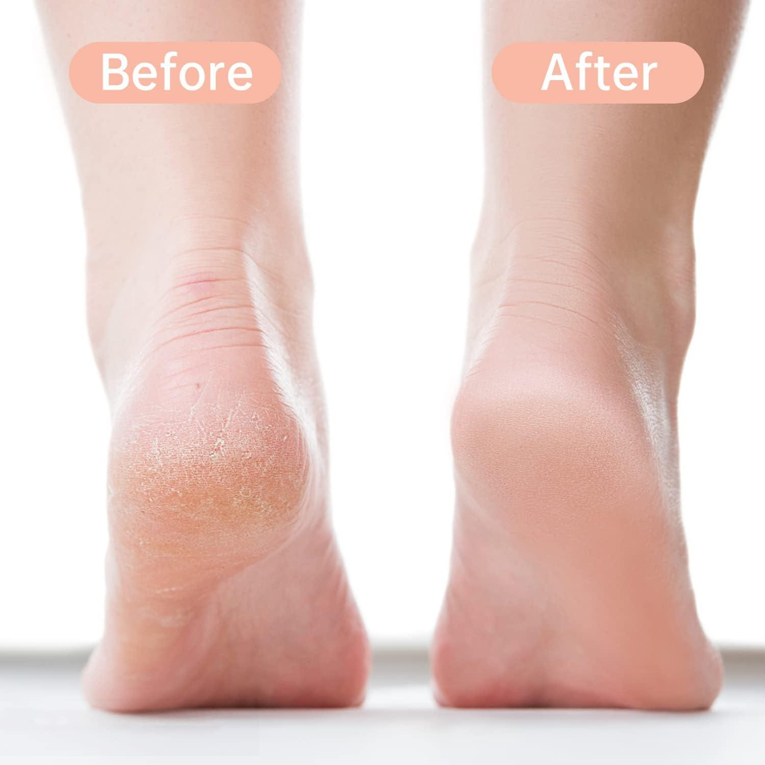 KIRA KIRA Double side Foot File Callus Remover For Feet, Feet Filer for Dead Skin Remover, Pedicure Foot Rasp, Foot Scraper to Remove Hard Skin For Men & Women (Black)