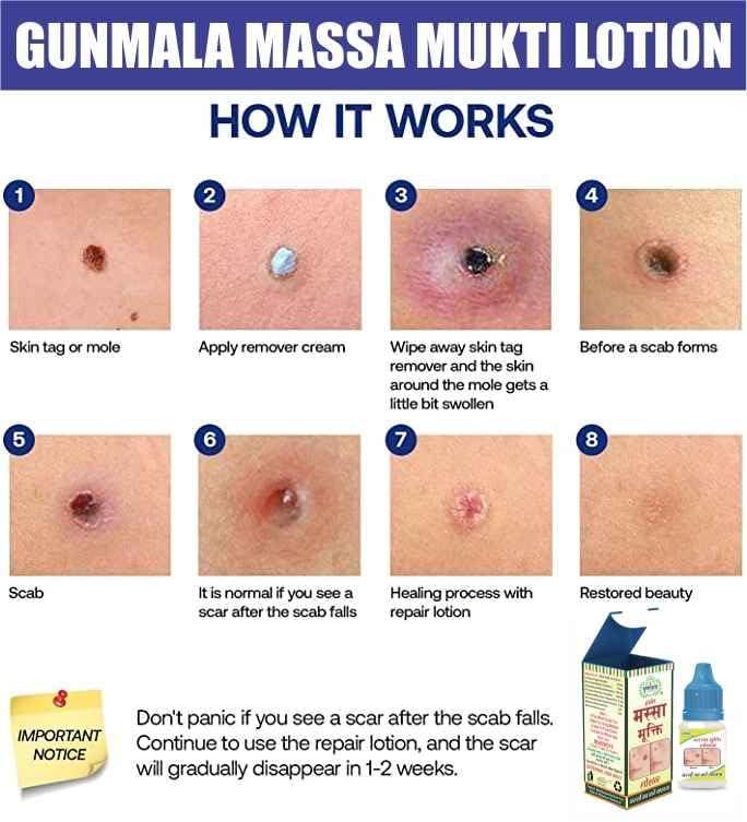 Gunmala Herbals Gunmala Herbal Massa Mukti Lotion - 20 Ml. (Ayurvedic Skin Tag Remover)