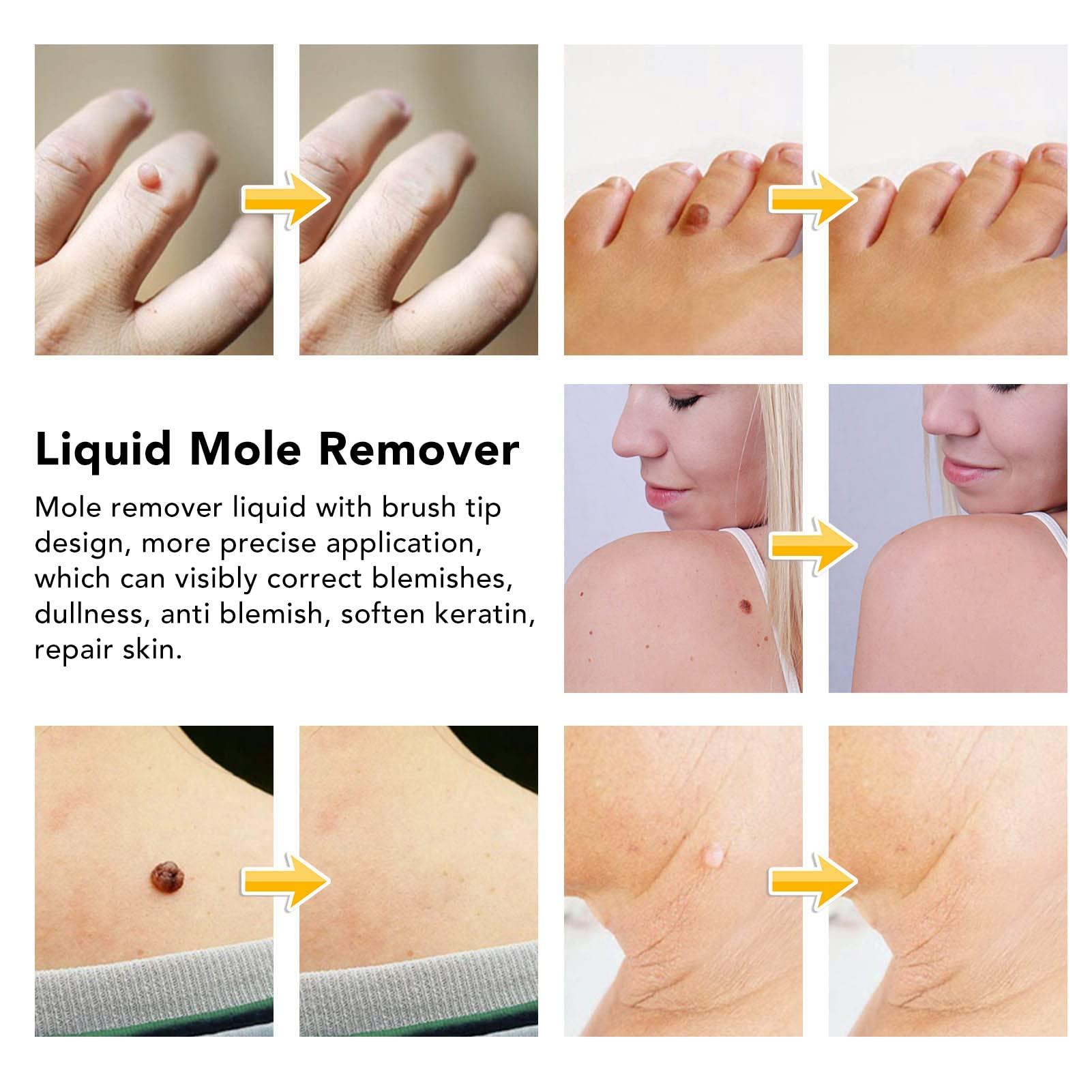 Jaerb Liquid Mole Remover, 30ml Painless Safe Mild Repairing Brush Tip Skin Tag Removal Liquid for Condyloma