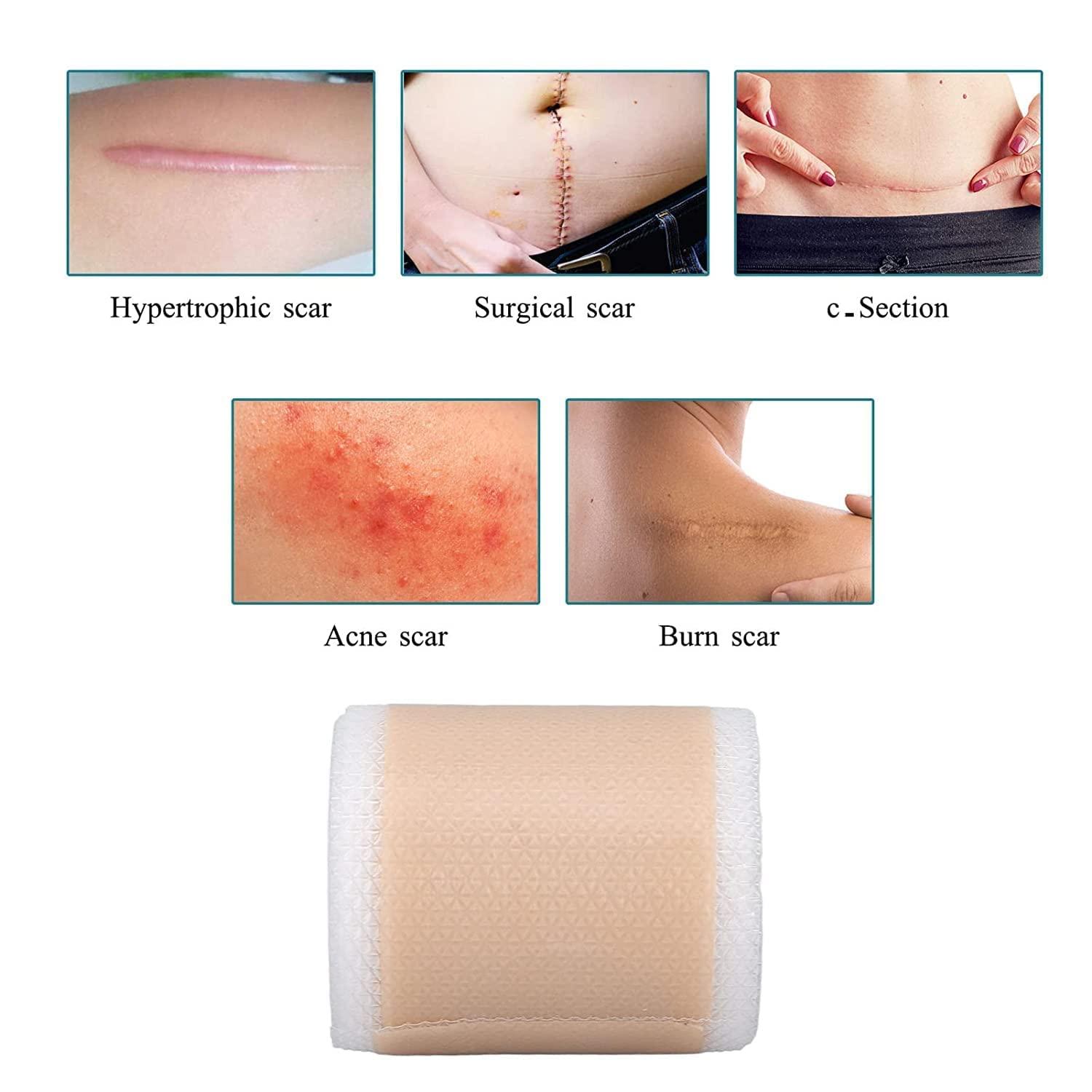 ZUMIE ZUMIE Silicon for Scars Recovery Medical Silicone for Scar Removal, Transparent Tear Silicone Tape Roll, For Hypertrophic Scars and Keloids Caused by Surgery (Scar Repair tape 2 Roll)