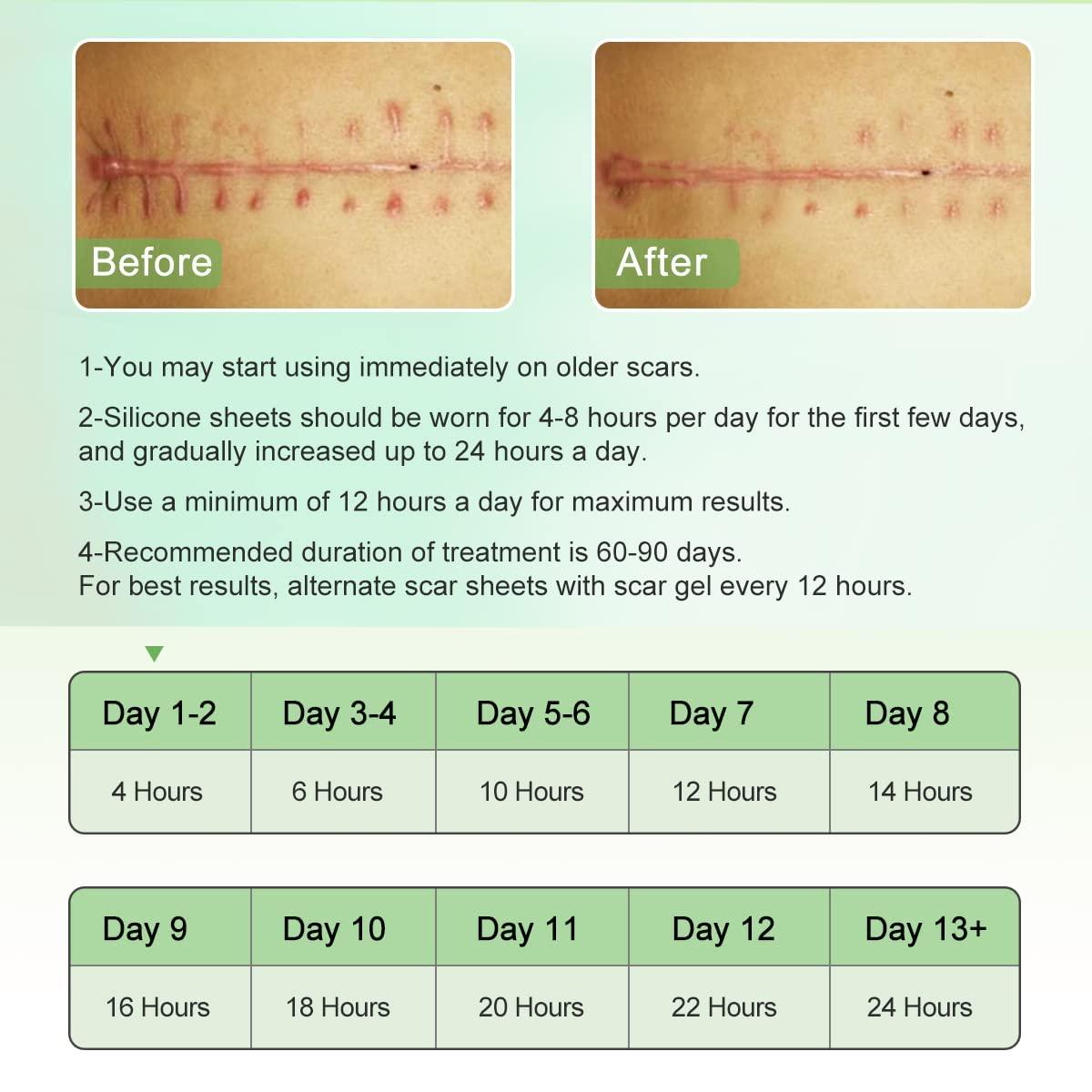 Kwinto Silicone Scar Sheets, Silicon gel sheets for Scars Transparent Medical Silicone Gel Tape for Scar Removal, Silicone Scar Tape Roll For Hypertrophic Scars and Keloids Caused by Surgery