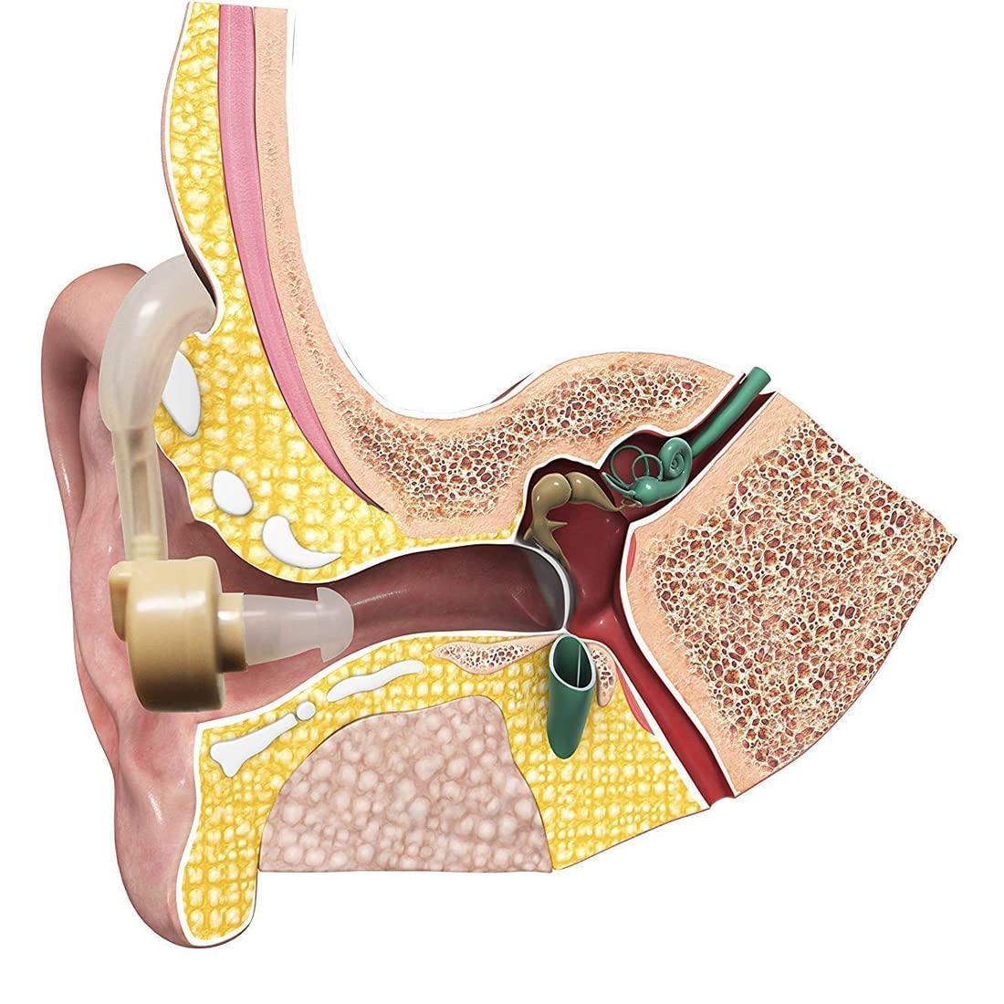 Generic Sonic Professional Normal to Modify Hearing Aid for any Age Unisex Behind the Ear Hearing Aid
