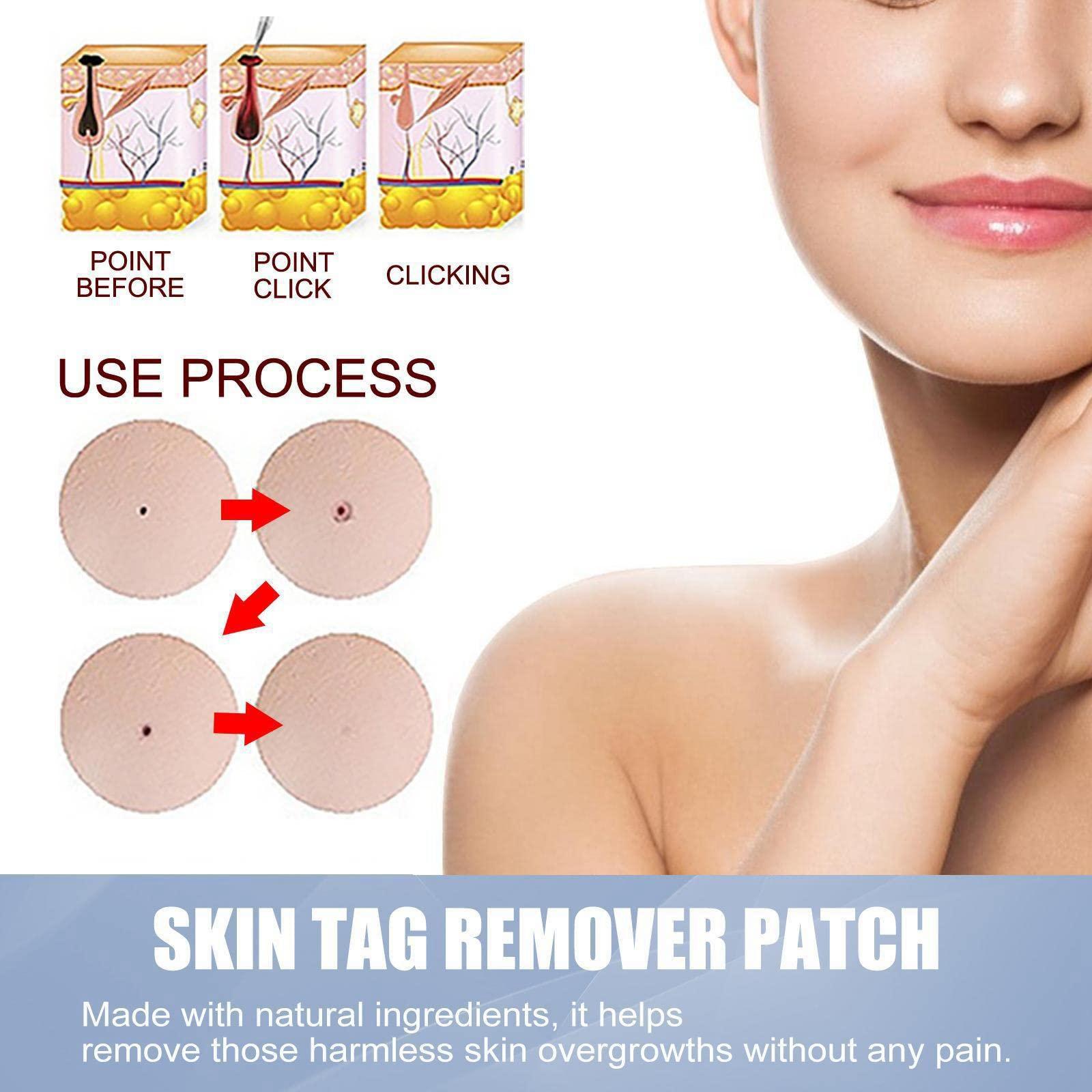 T.O.G. T.O.G. 144 Pieces Mole Wart Remover Day and Night Use Mild for Face Back Armpit