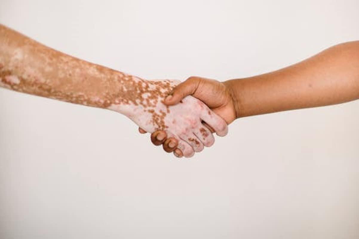 Arogya Ayurveda Kendra Herbal Remedy for Vitiligo & Leukoderma Helpful in disappearing White Patches from Skin.- Ayurveda Gift