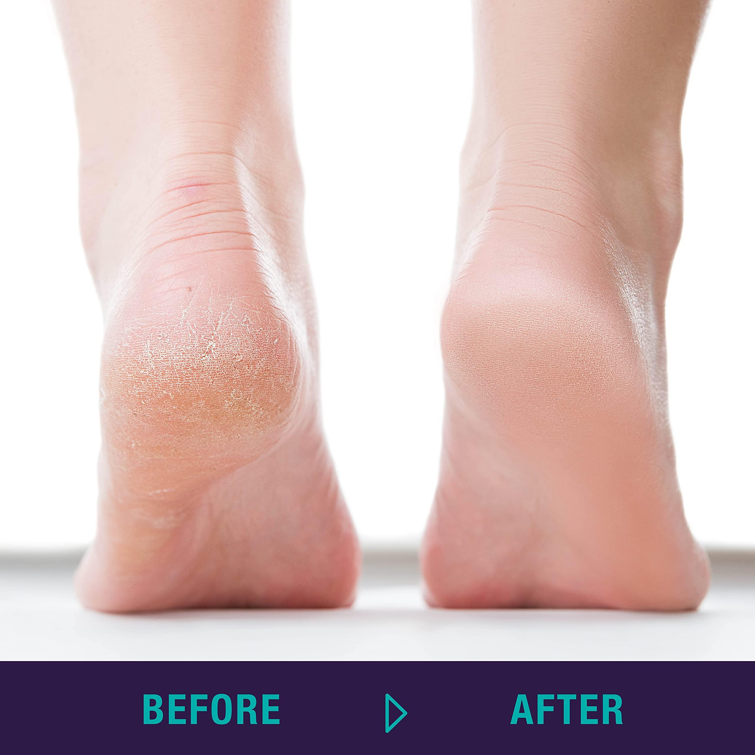 Trim Simply Foot Rasp/Callus Remover for Feet Dual-Sided Foot File for Calluses Rubber Grip for Comfort and Control Easy to Use Foot Care Tools for DIY Pedicures Ideal for Men and Women