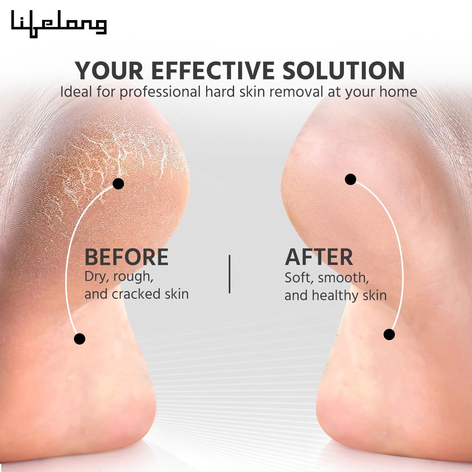 Lifelong Lifelong Callus Remover for Feet | 1 Year Warranty | Foot Scrubber for Dead Skin, 3 Roller Heads, Feet Dead Skin Remover, Pedicure Machine, LED Display, Fast Charging, 2 Hour Runtime (White)