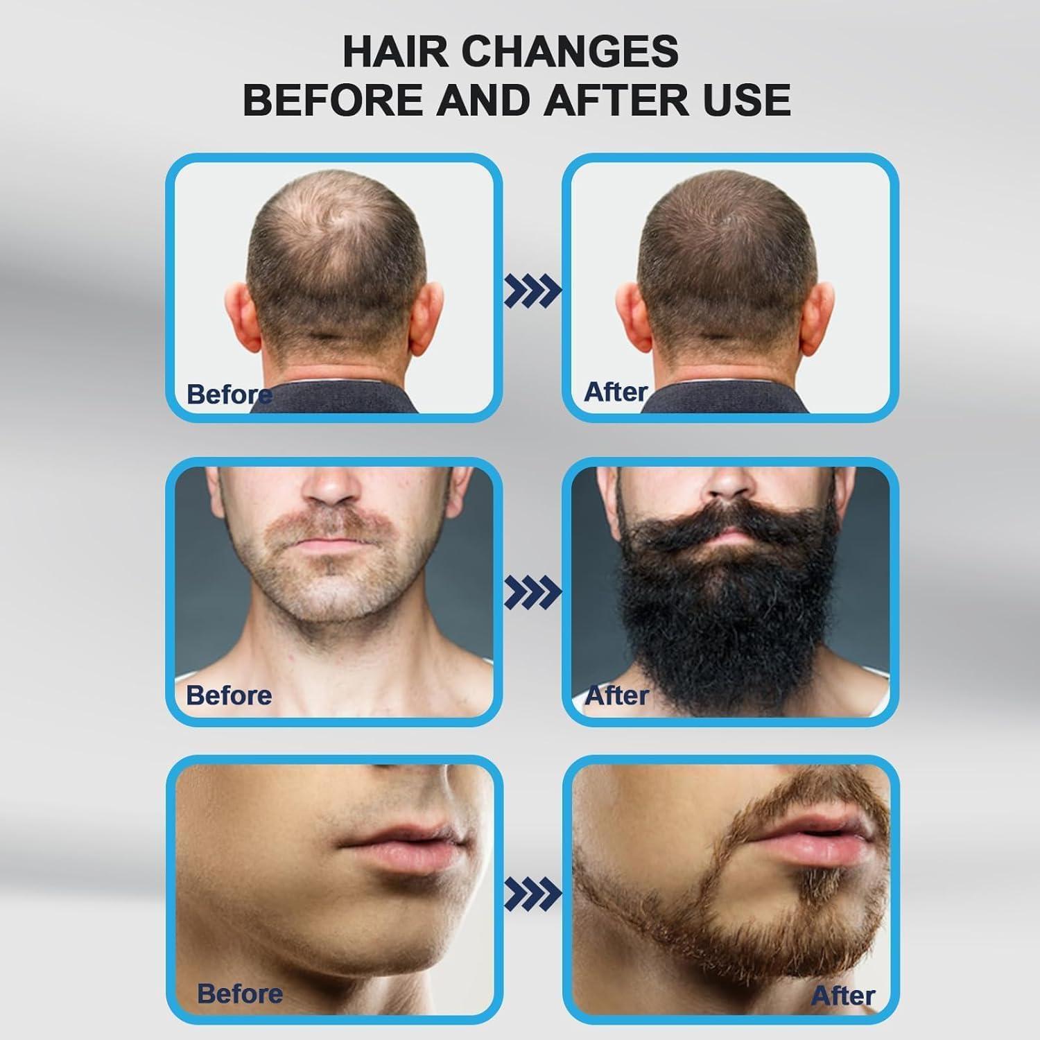 DUNGRANI ENTERPRISE Derma Stamp Adjustable Pen 0mm - 3mm,140 A Titanium micro needles I Amazing Professional Microneedling Pen for Skin Repair, Face, Hair & Beard Growth (Derma Stamp)