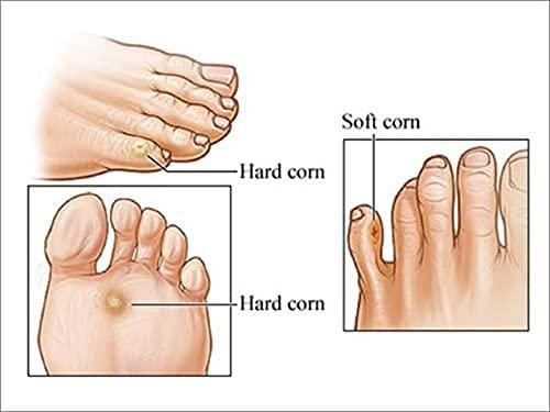 CTM EXPORTS CTM EXPORTS A.K.S Ointment for Kaal Aani Cream - Foot Corn Remover, Hand Corn Remover, Callus Remover, Kapasi Remover Cream/Malam (10g) (1)