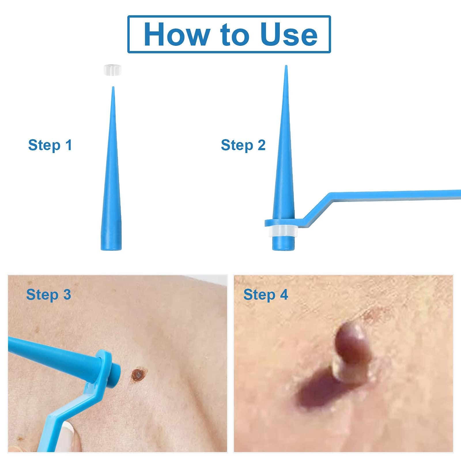 RYAP Skin Tag r Set Skin Tag Removal Kit with Skin Tag Removal Rubber Bands for Removing Medium to Large (4mm to 8mm) Sized Skin Tags Painlessly