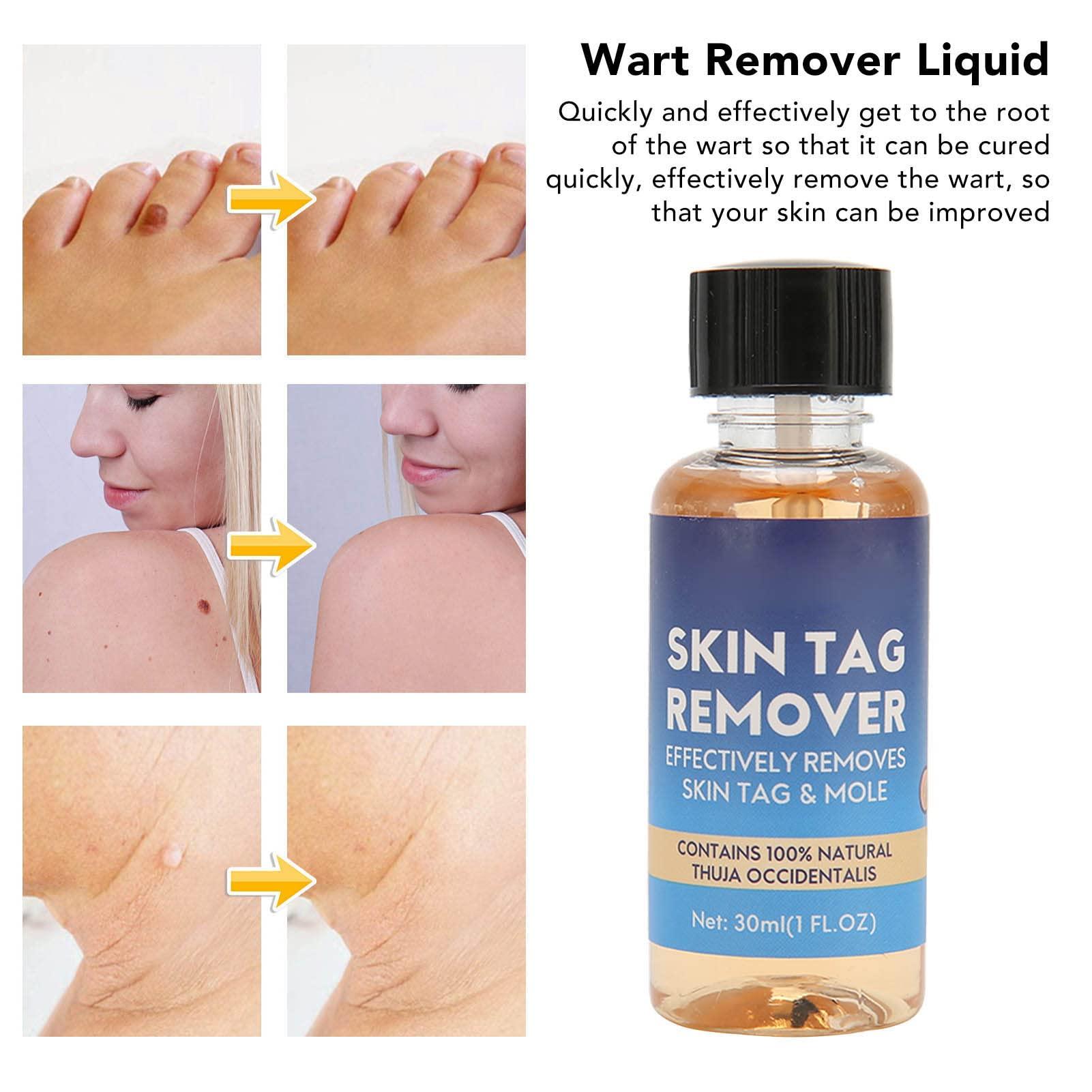 Jaerb Liquid Mole Remover, 30ml Painless Safe Mild Repairing Brush Tip Skin Tag Removal Liquid for Condyloma