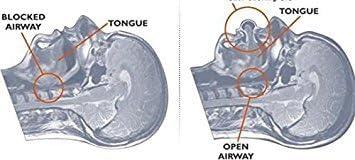 VALUEVIBES Anti-Snoring Tongue Device Medical Silicone Sleep Aid for Snoring Relief, Effective Stop Snore Sleeve for Sleep Apnea Solutions (Blue)