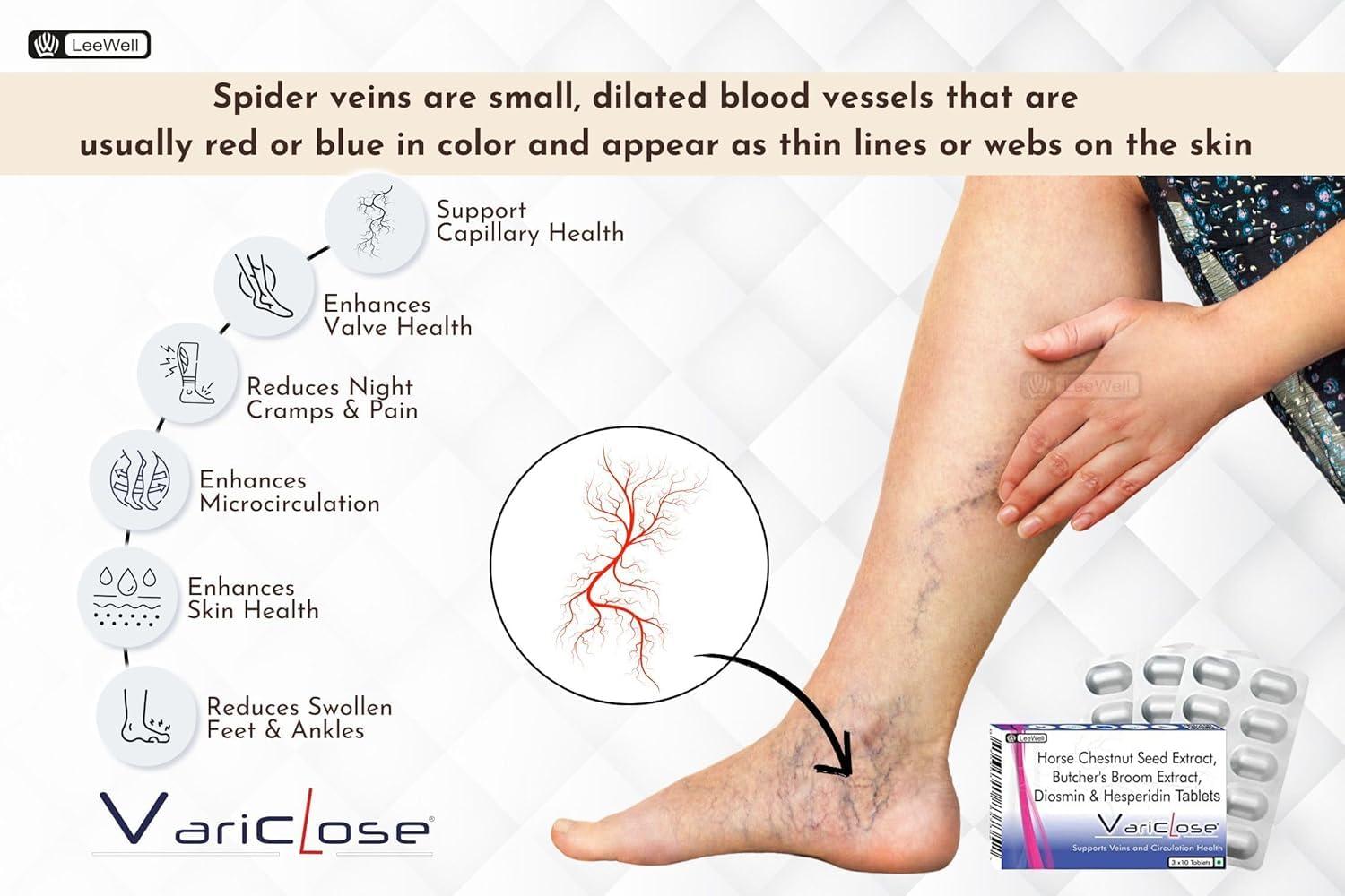 VARICLOSE Variclose Support Varicose Veins, Spider veins | Diosmin, Hesperidin, Horse Chestnut extract (Aescin), Butchers broom extract (Ruscogenins) | Plant based Foot, Legs Vascular Micro Circulation Support Supplement -60 Tablets