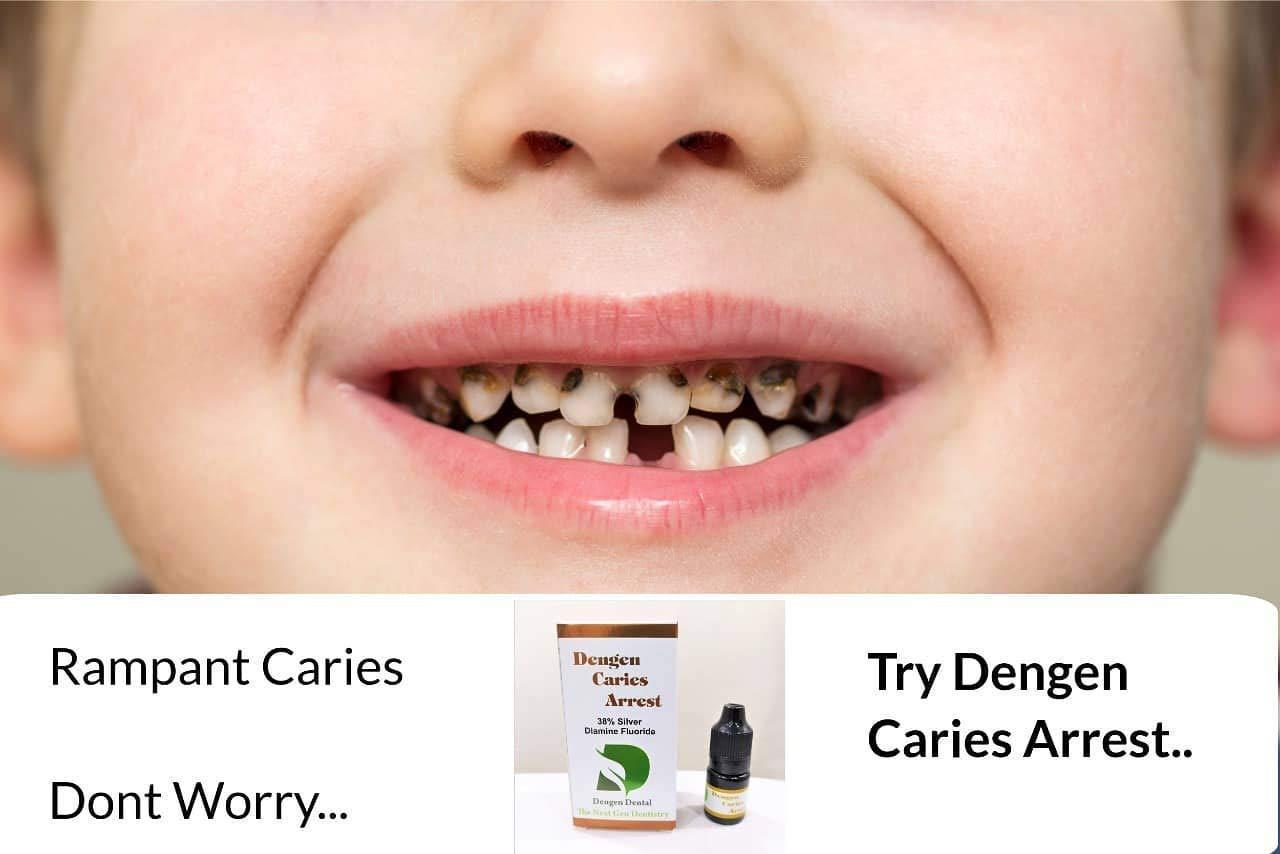 Dengen Dental Dengen Caries Arrest Silver Diamine Fluoride