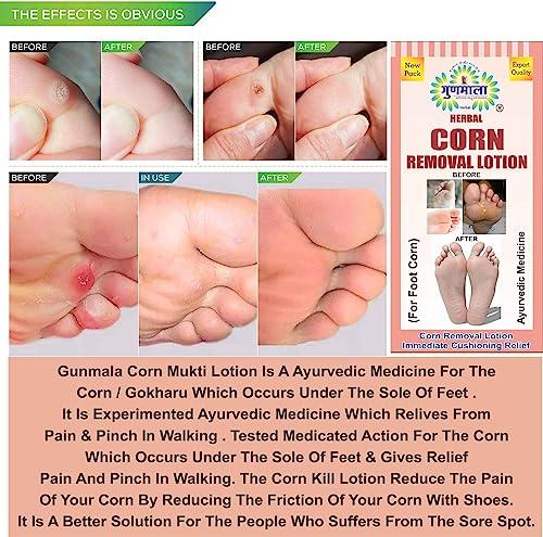 GUNMALA Herbal Foot Corn Lotion, For Remove Feet Fast And Relives From Pain & Pinch In Walking Best For Feet Infections, 5 Ml. Bottel Pack,Qty.-Pack Of 2