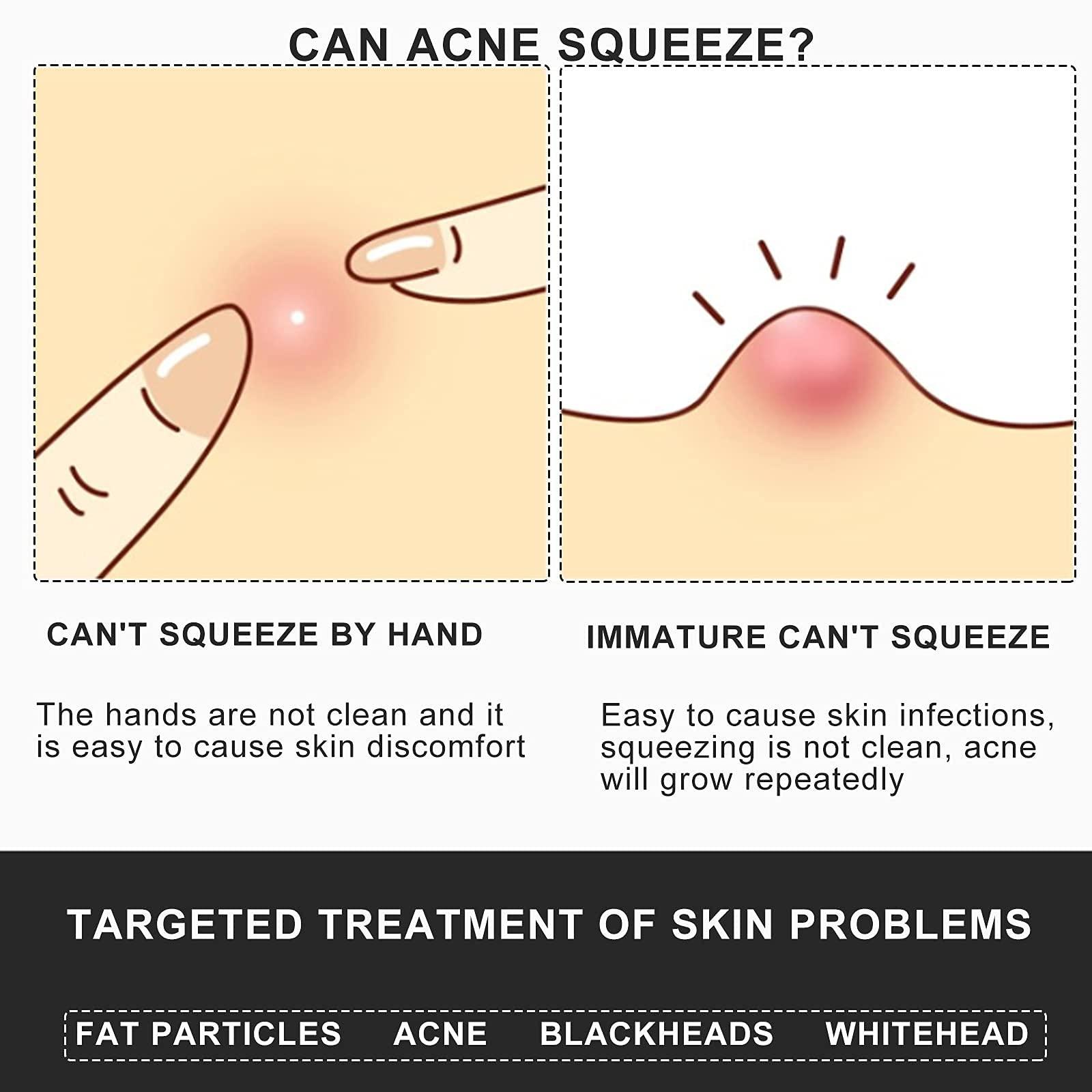 MUZE MUZE Professional Facial Milia Removal and Whitehead Pointed Tweezers - Precision Sharp Needle Nose Tool for Blackhead ,Pimple Popper & Fat Particles Remover - Zit and Pimple Acne Removal