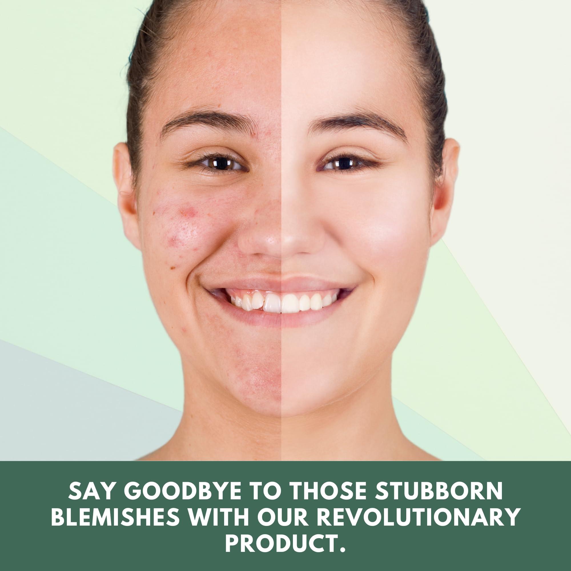 Healthy Nutrition - Just for the Health of it Healthy Nutrition - Just for the Health of it Neem For Acne Free Skin, Blood Purifier To Reduce Pimples On Face (60 Tablets)