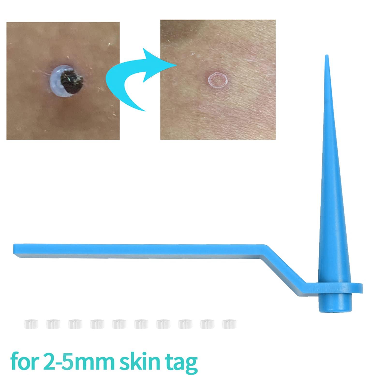 RYAP Skin Tag r Set Skin Tag Removal Kit with Skin Tag Removal Rubber Bands for Removing Medium to Large (4mm to 8mm) Sized Skin Tags Painlessly