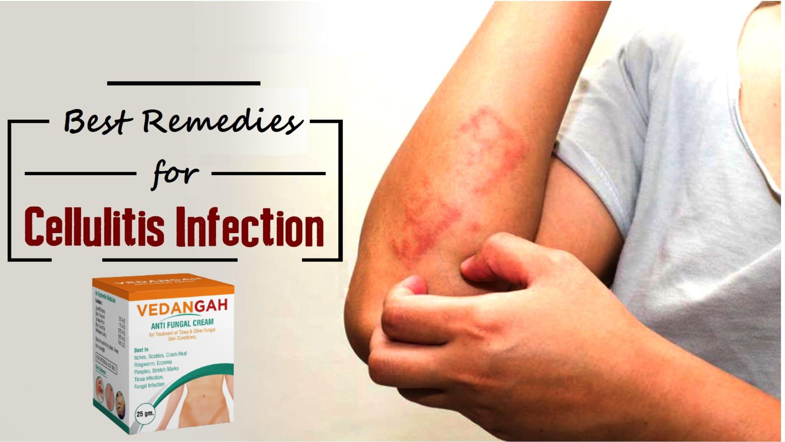 VEDANGAH VEDANGAH Anti Fungal Cream | Anti-Itching Skin Cream | Eczema | Psoriasis | Ringworm Cream 12Gm Pack Of 2