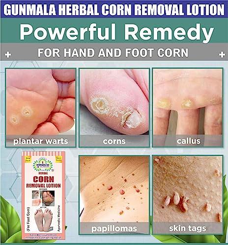 Ayurvedic treatment for 2024 corns in foot