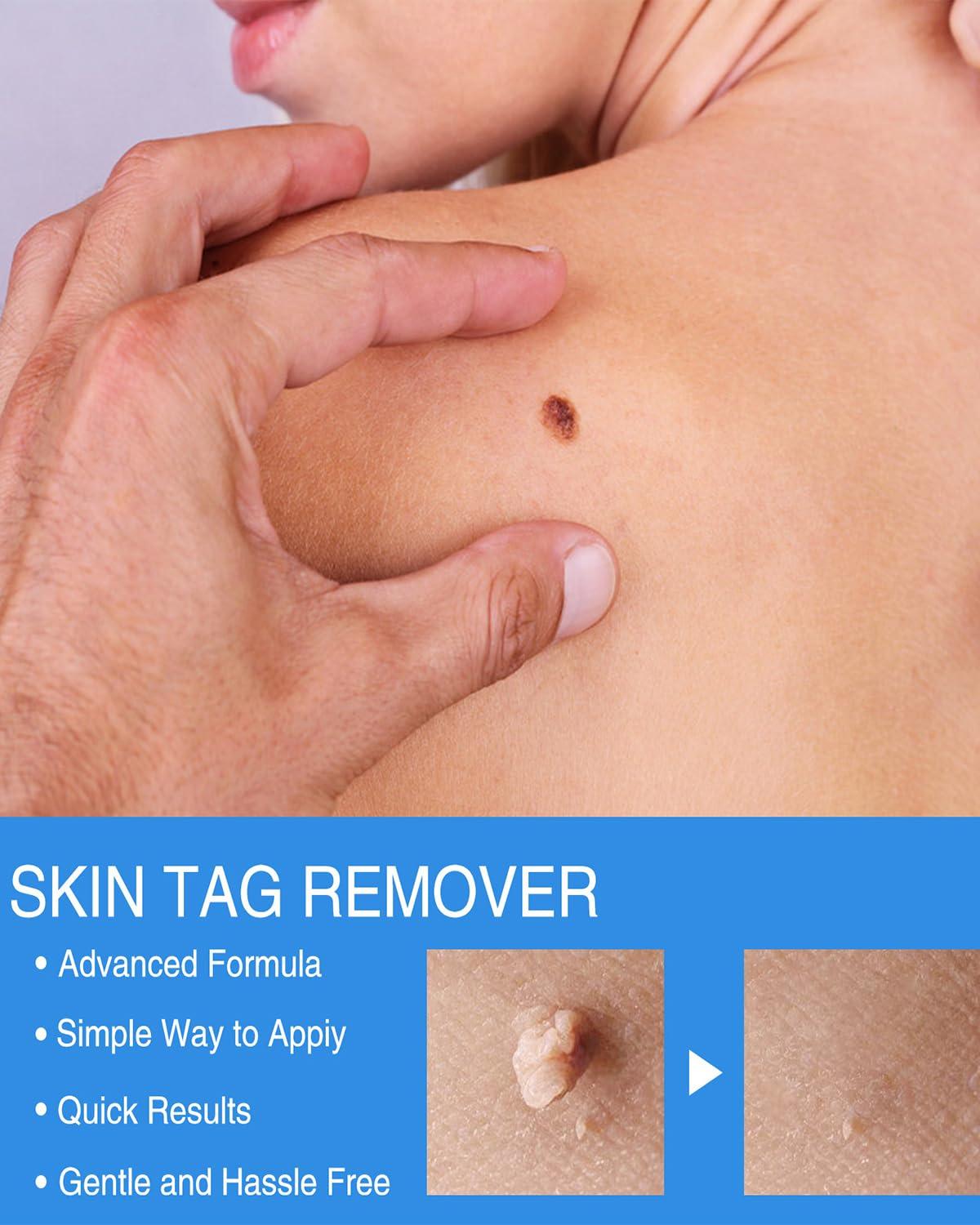 NHCDFA Skin Tag Remover Cream, Best Skin Tag Removal, Skin Tag Remover Kit, 3 in 1 Skin Tag Removal with Auto Skin Tag Remover, Face Care Mole Wart Tool, Skin Tag Remover Set