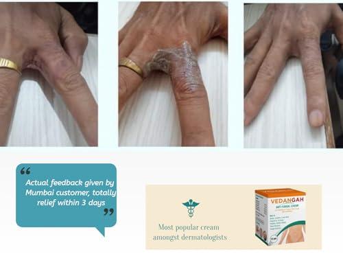 VEDANGAH VEDANGAH Anti Fungal Cream | Anti-Itching Skin Cream | Eczema | Psoriasis | Ringworm Cream 12Gm Pack Of 2