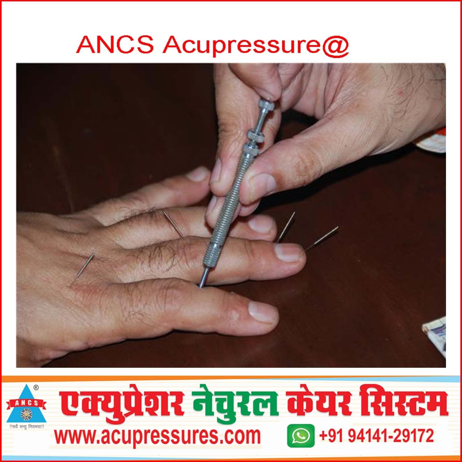 ANCS ANCS Sujok Acupressure Needle Inserter with Sujok Needle (Total Set of 50 Needles)
