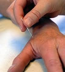 Acupro Health Care System Acupro Health Care System_Acs dry needles physiotherapy (0.25x13)