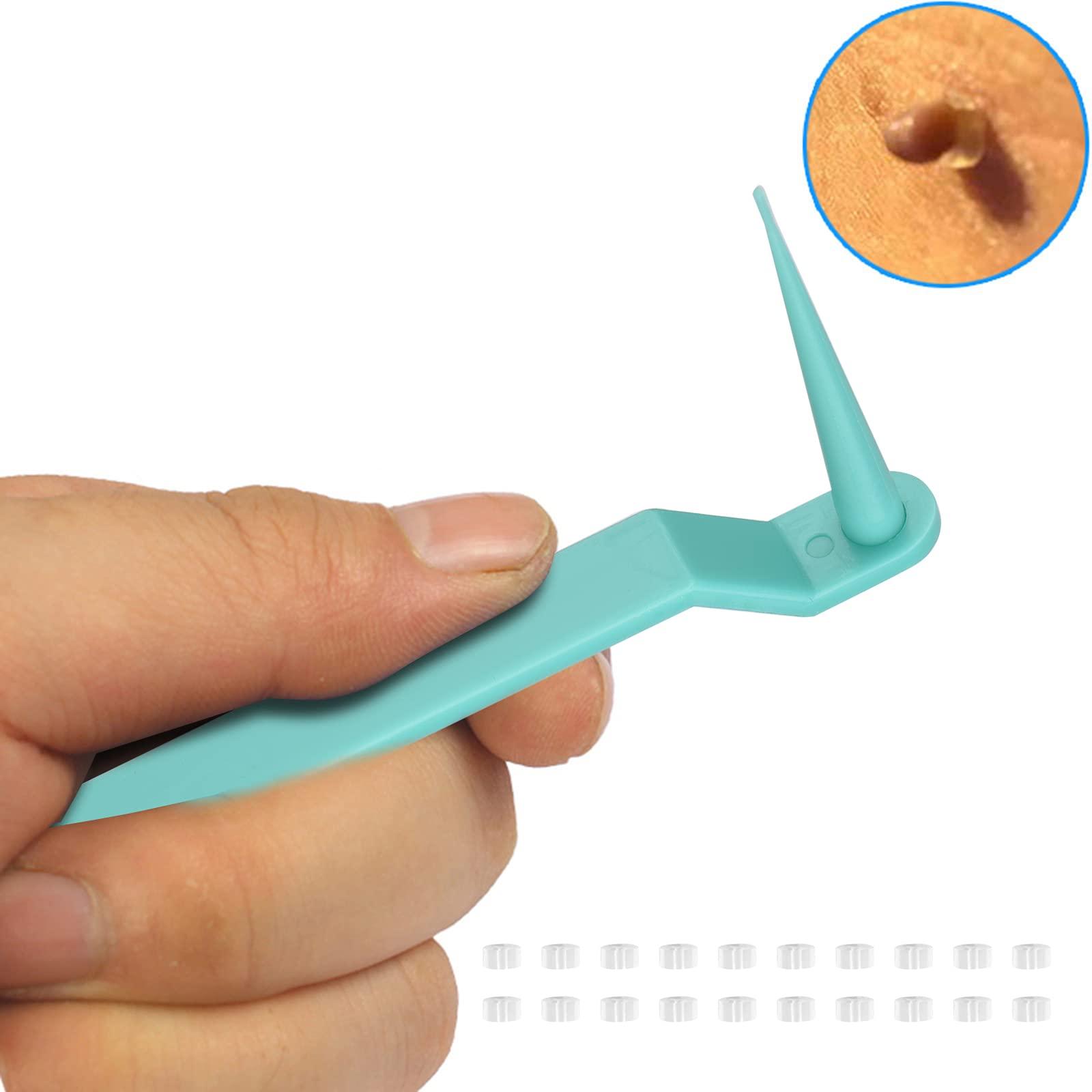 RYAP Skin Tag r Skin Tag Removal Kit for Removing Small to Medium (2mm to 4mm) Sized Skin Tags Painlessly