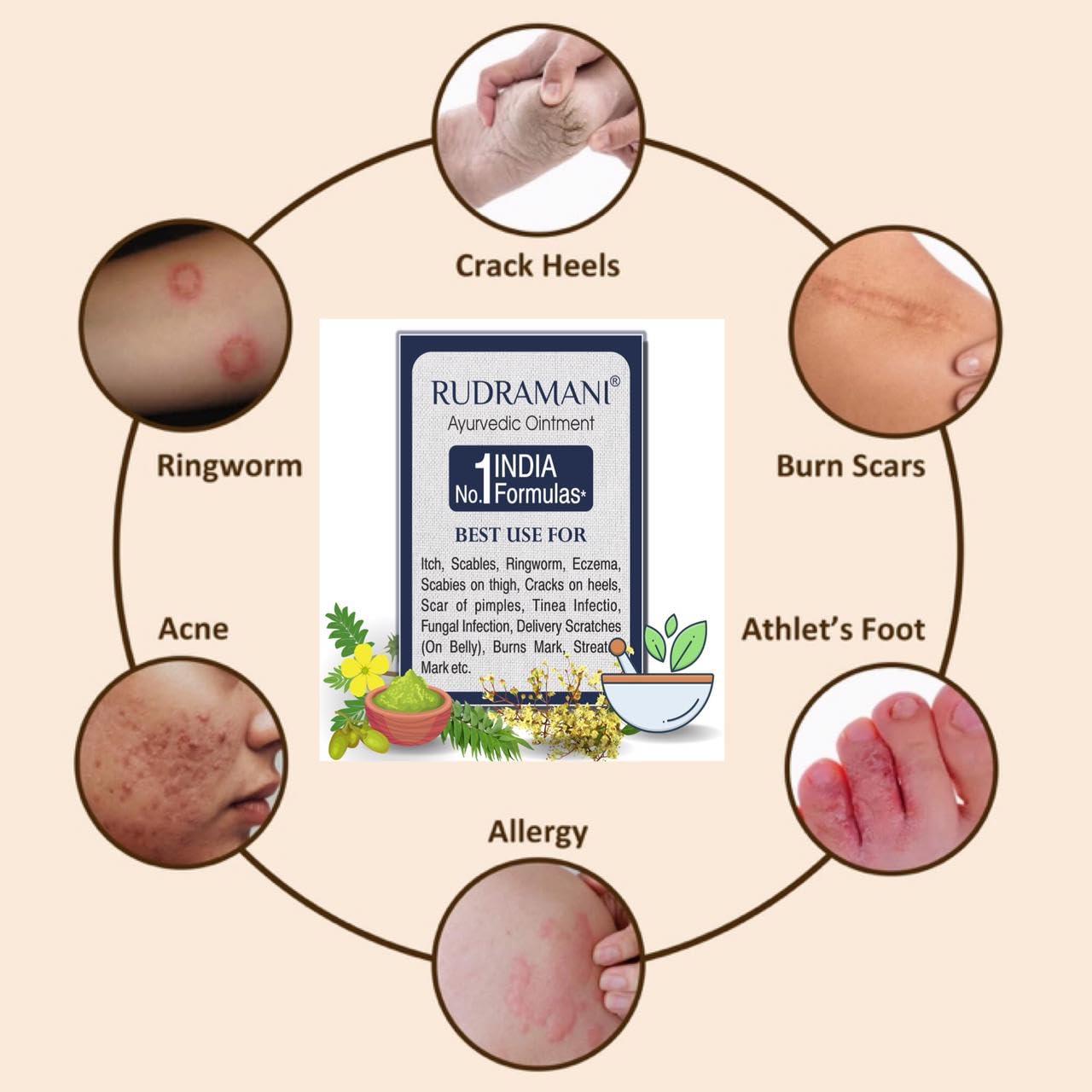 Generic Rudramani Marham Malam Dad Khaj Khujli fungal Ointment - for Ringworm, itching & Skin Infection, Skin Tretment, Skin Care. (25GRAM)