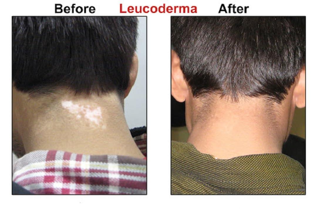 Arogya Ayurveda Kendra Herbal Remedy for Vitiligo & Leukoderma Helpful in disappearing White Patches from Skin.- Ayurveda Gift