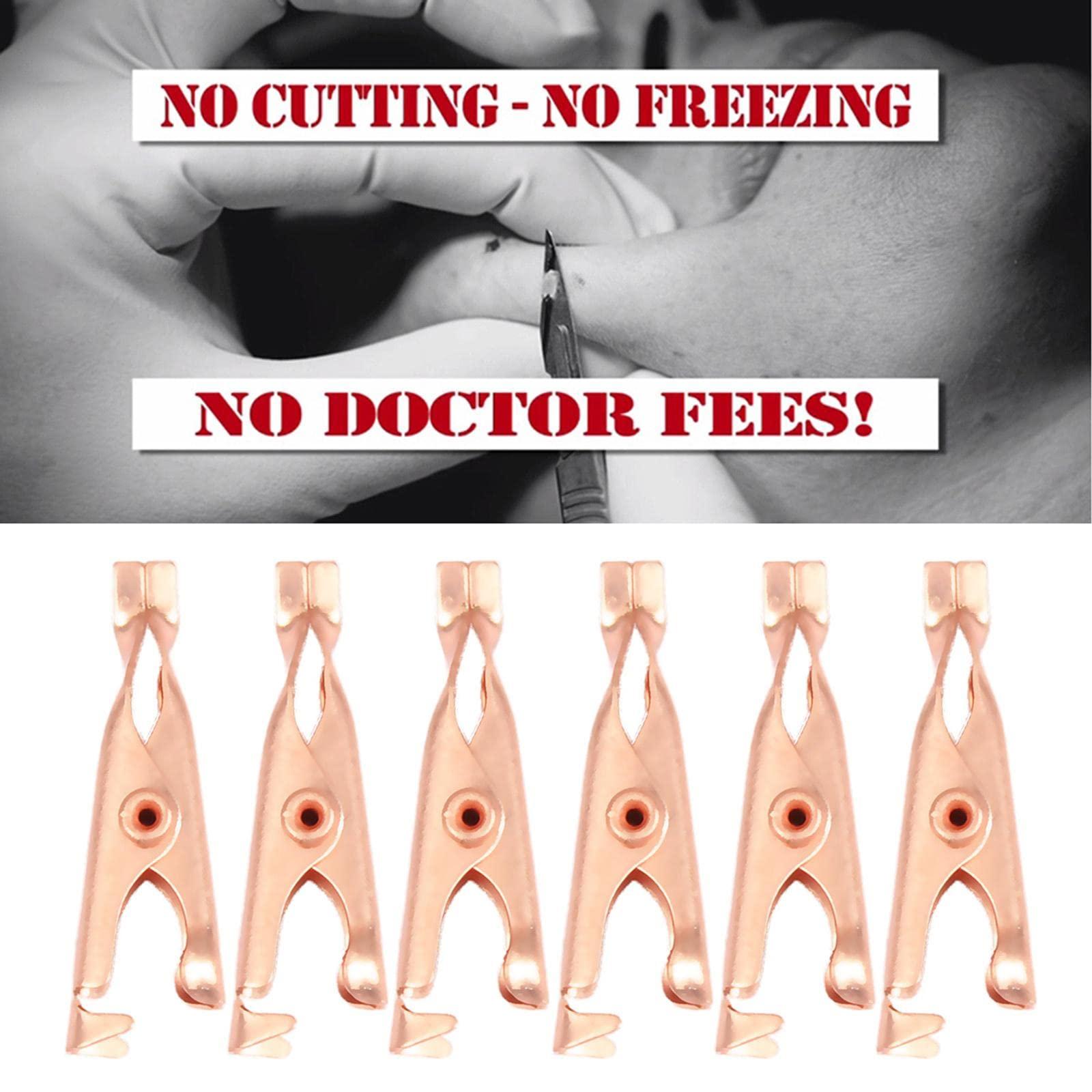 T.O.G. T.O.G. Small Skin Tag Removal Clips Copper Tag Out Wart Tag Extractor Unisex 12Pcs