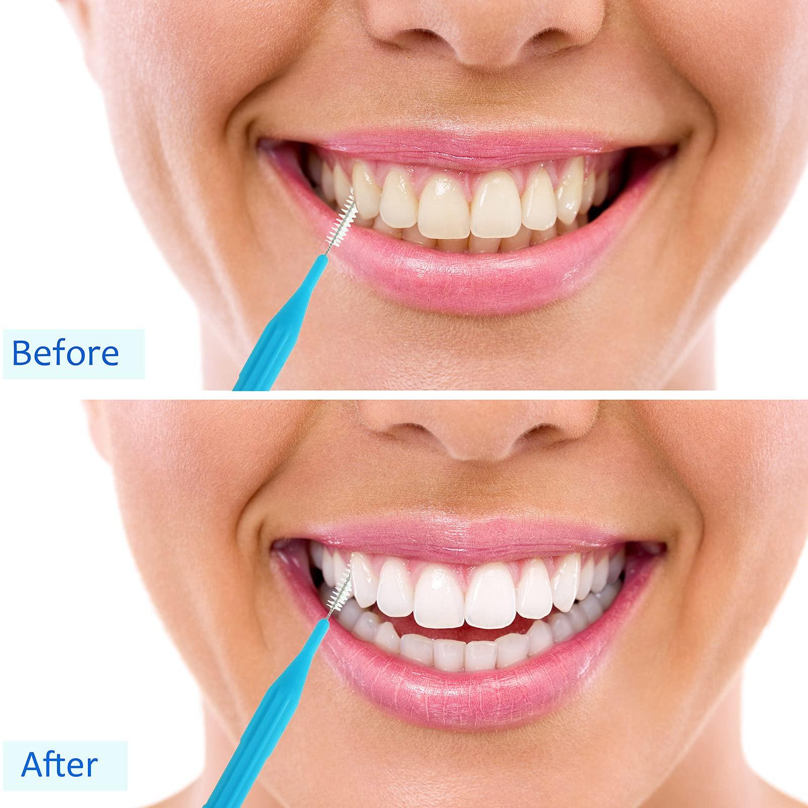 Patelai Patelai Kid 100 Pieces Braces Manual Brush For Cleaner Interdental Brush Toothpick Dental Flossing Head Oral Hygiene Flosser Tooth Cleaning Tool (Stylish Colors),Assorted