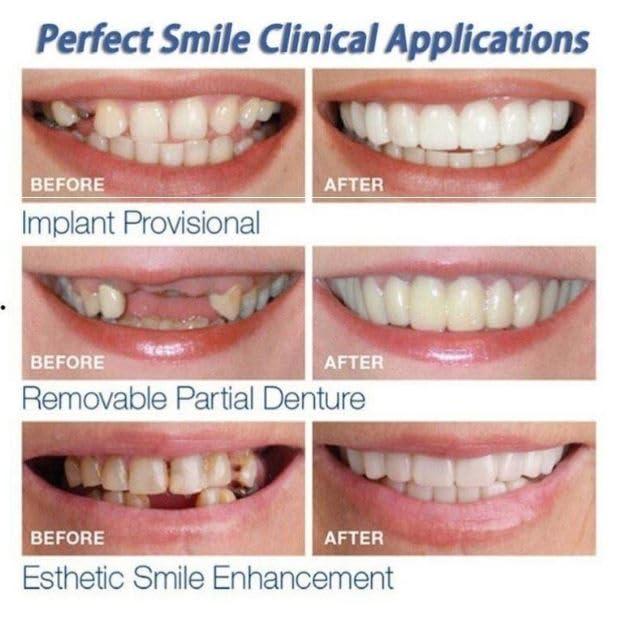 Zemiss Snap On Teeth Veneers Nonporous Dentures For Men Women Cover The Teeth Instant Confident Smile Temporary Teeth