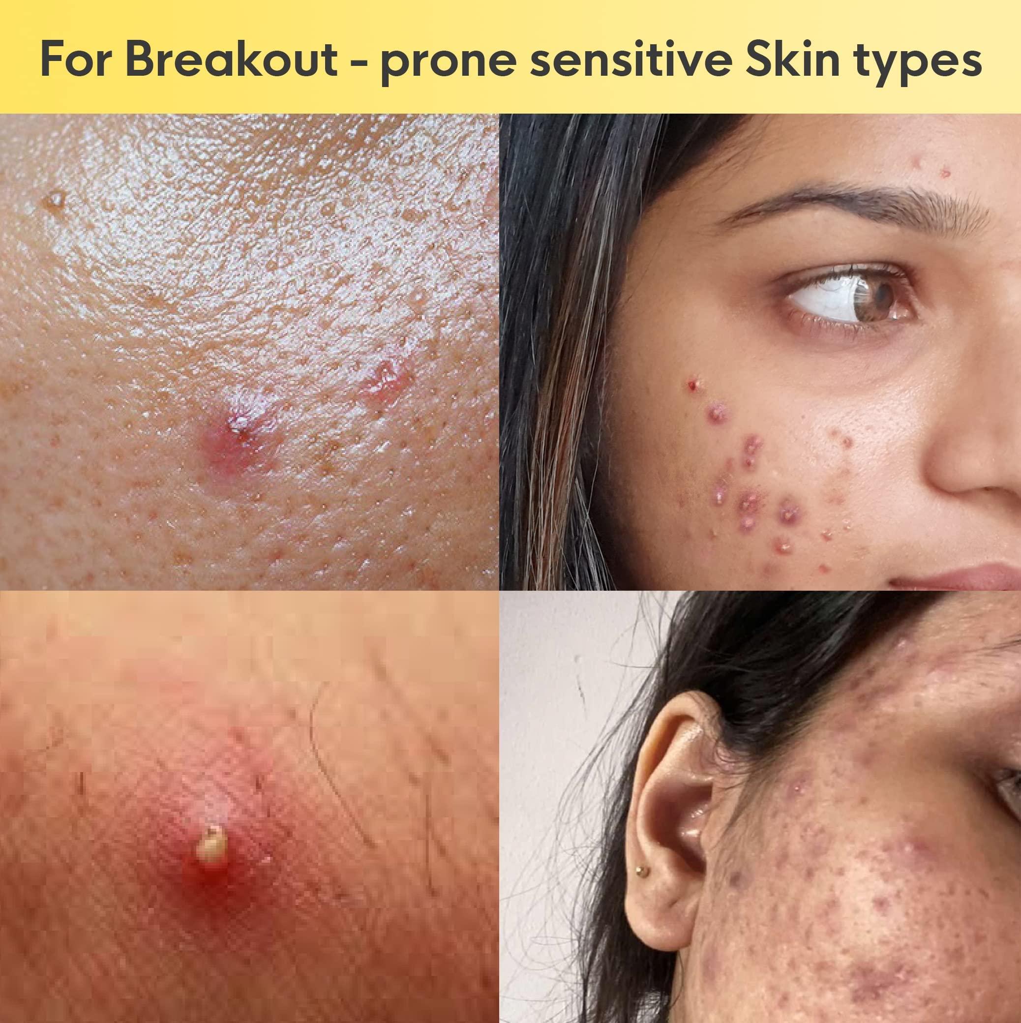 I AM LOVE I AM LOVE Acne Negative (-Ve) Supplement Powder - 60G|Reduce Excess Oil, Mild To Moderate Acne Pimples & Open Pores|Plant-Based Skin Supplement With B Complex Vitamins, Zinc, Chromium