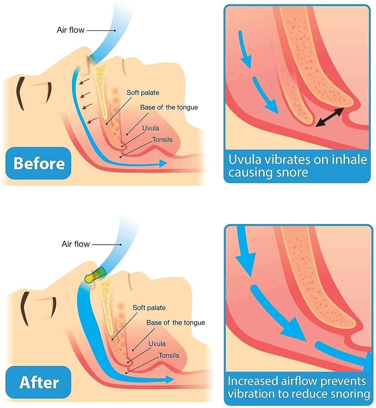 Brocade Enterprise Snore Free Nose Clip | Unisex Stop Snoring Anti Snore Free Sleep Silicone Magnetic Nose Clip | Nose Clip | Anti Snoring device (SNORE FREE)