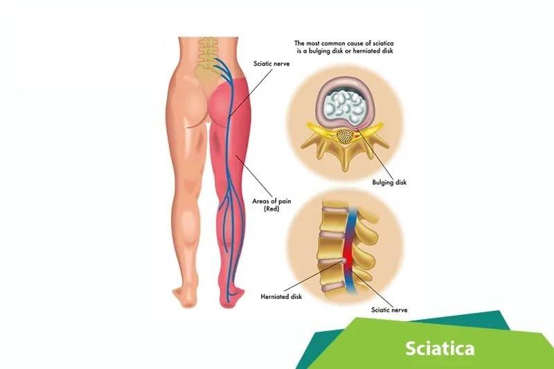 khajuraho Khajuraho Auyvedic Sciatica Care Pain Relief Kit | Dose for Scitica Disease Back Nerve One Side Leg Pain (Pack Of 3)