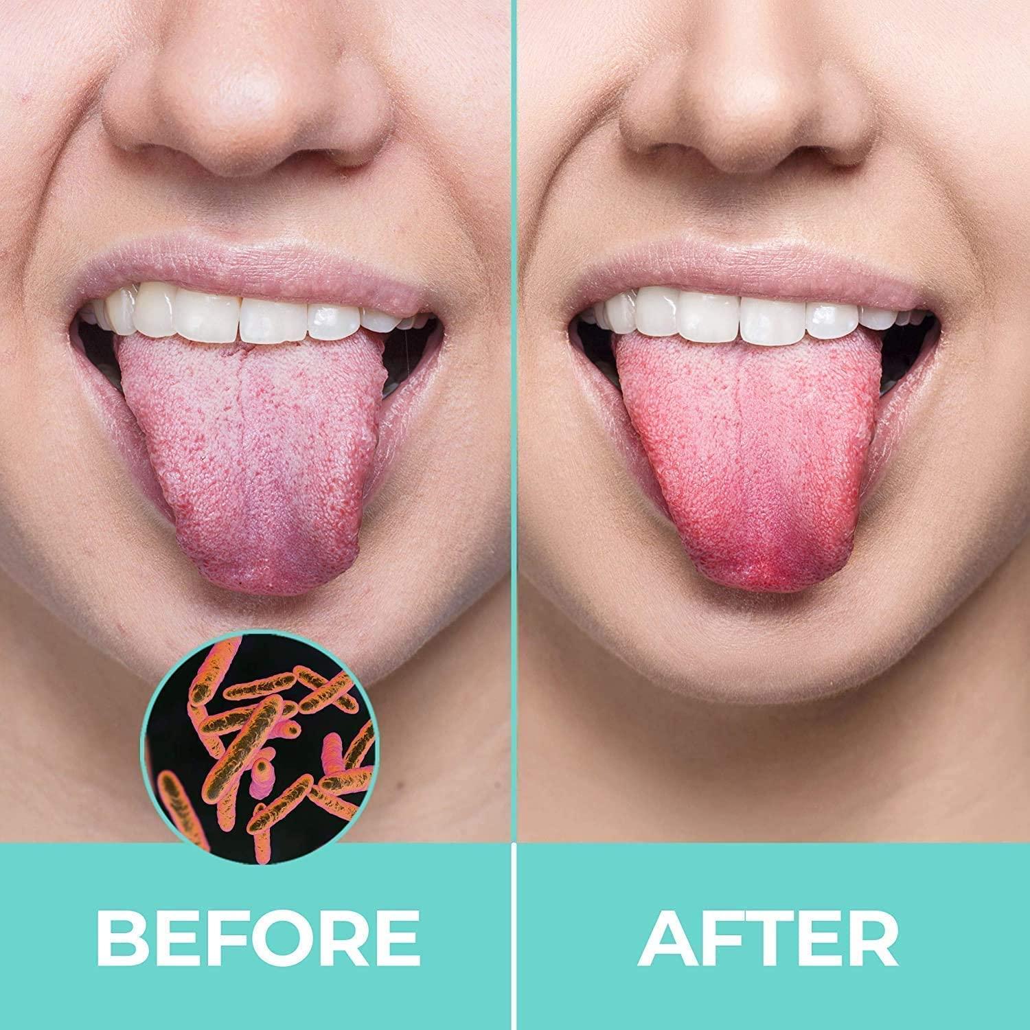 OVEERA OVEERA Steel Tongue Cleaner -Tongue scrapers for adults with Surgical Grade, Non-synthetic Grip, Tongue Cleaners (Pack Of 5)